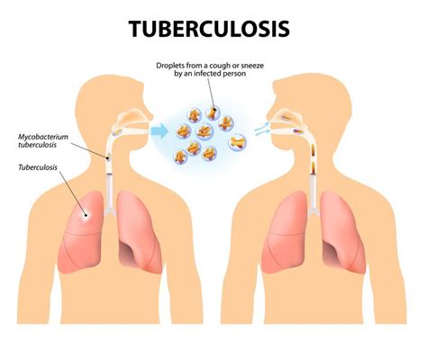 pinayflix2.tb|how does tuberculosis affect the respiratory system.